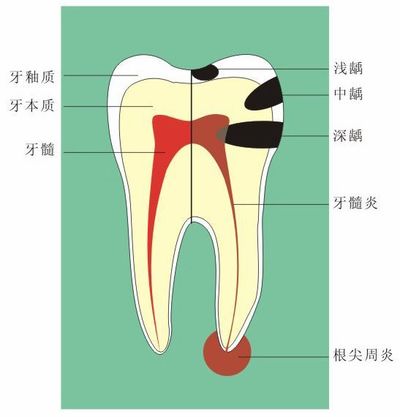 宝宝龋齿是如何形成的？